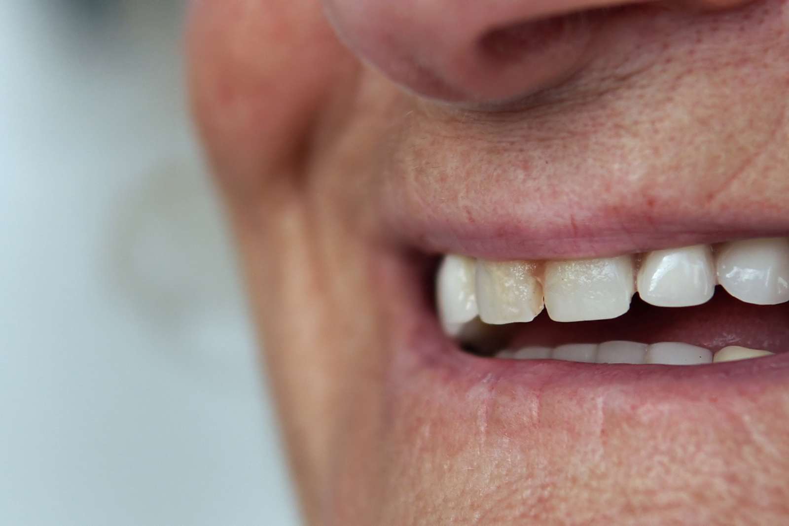 Et si la maladie d’Alzheimer commençait... dans votre bouche ?